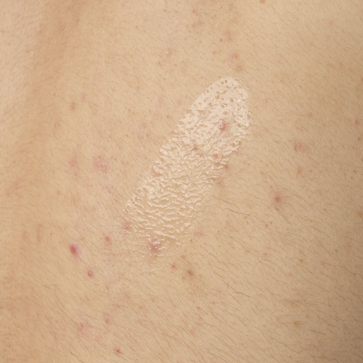 salicylic-acid-0-5-body-serum-v3 ORD-salicylic-acid-05-body-240ml-application.jpg