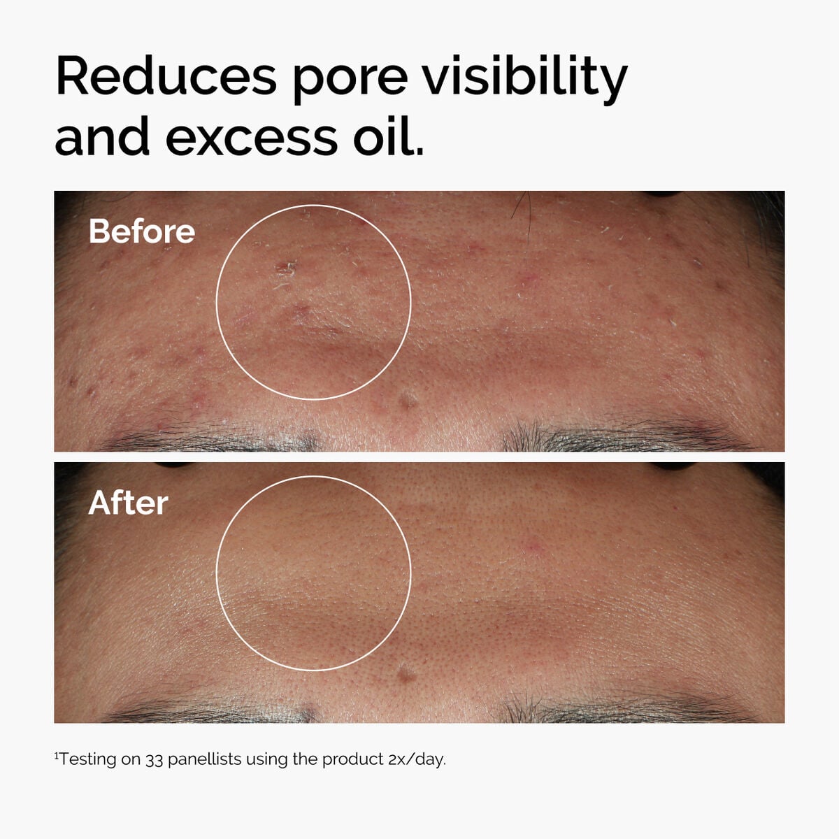 niacinamide-10-zinc-1-w8 ord-niacinamide-zinc-blemish-serum-before-after-pores.jpg