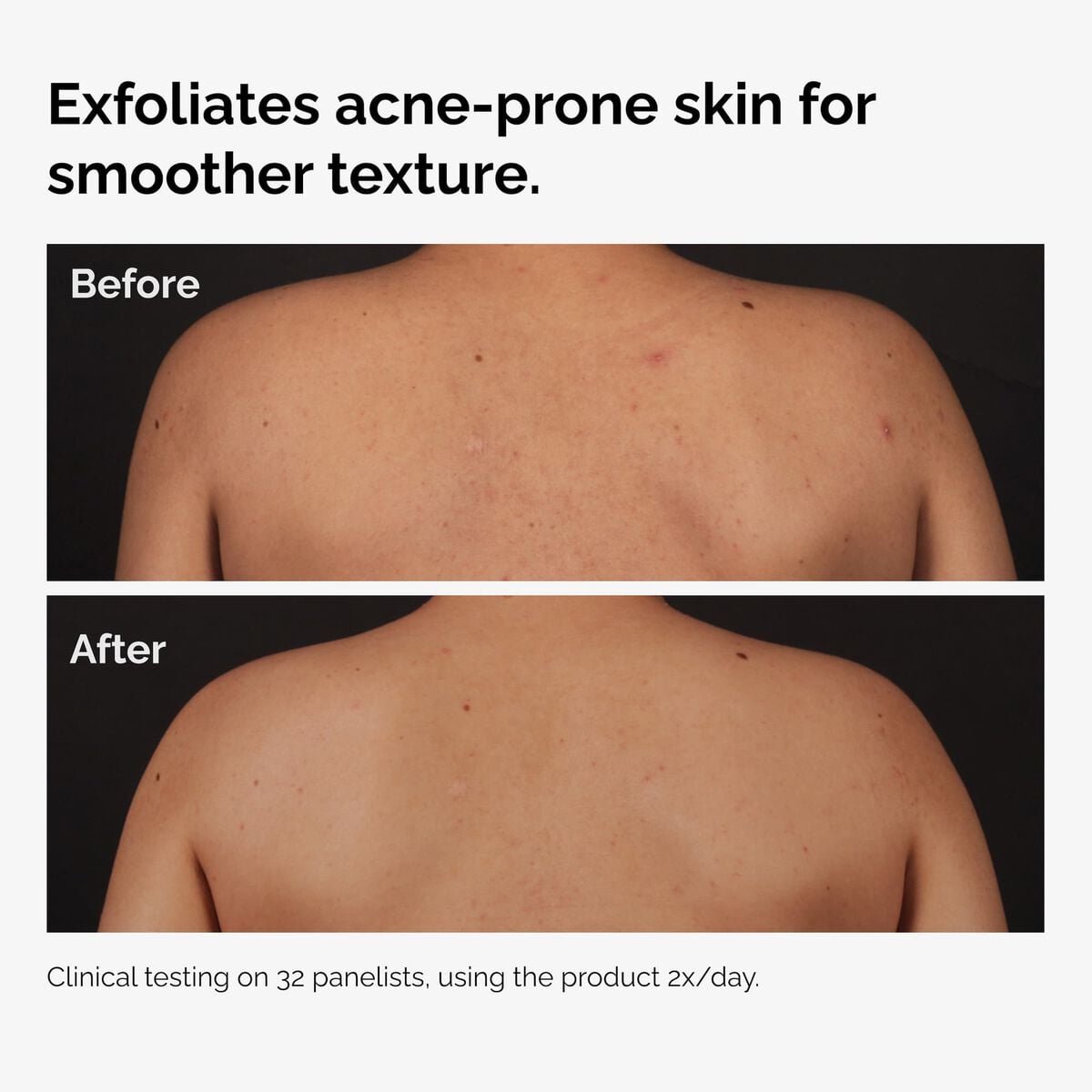 salicylic-acid-0-5-body-serum-v3 ord-salicylic-acid-body-serum-before-after-graphic-NA.jpg